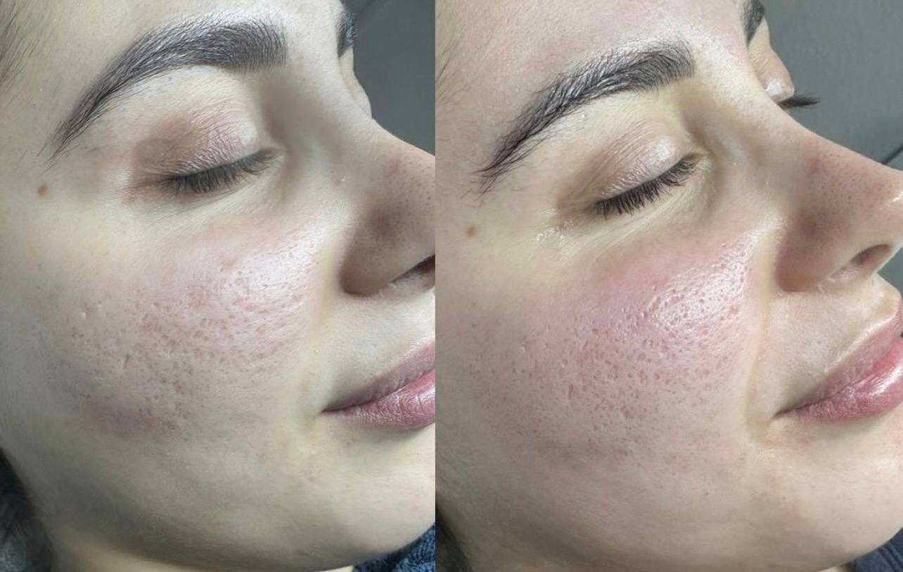 Microneedling: Der ultimative Guide für straffe Haut in Basel