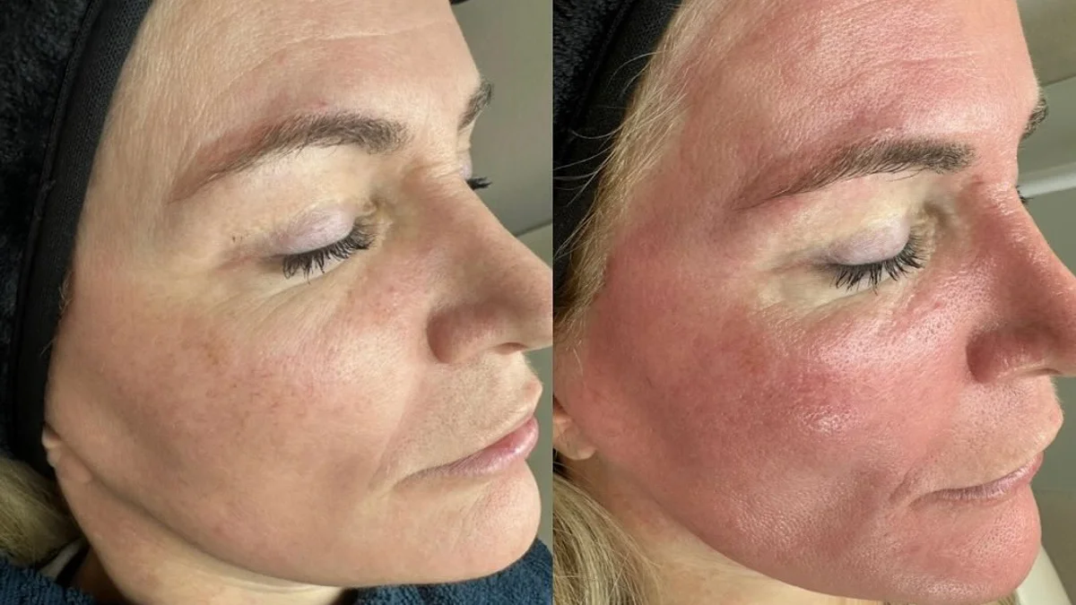 BioPeelX bei DeMas Beauty in Muttenz