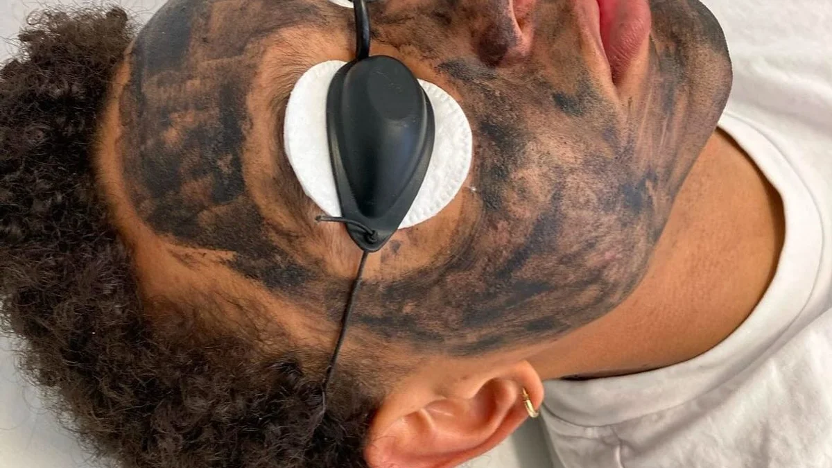 Carbon Laser Peeling bei DeMas Beauty in Muttenz