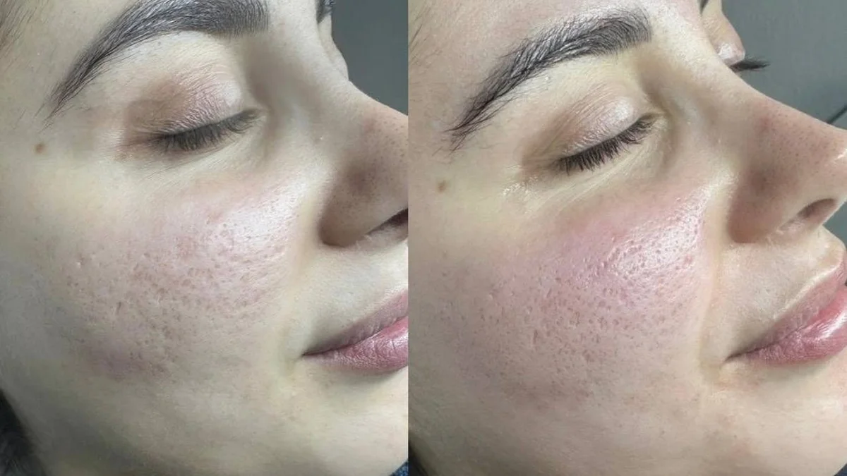 Microneedling bei DeMas Beauty in Muttenz