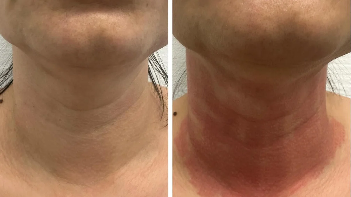 Fibroblast Plasma (Plasmatrix) bei DeMas Beauty in Muttenz