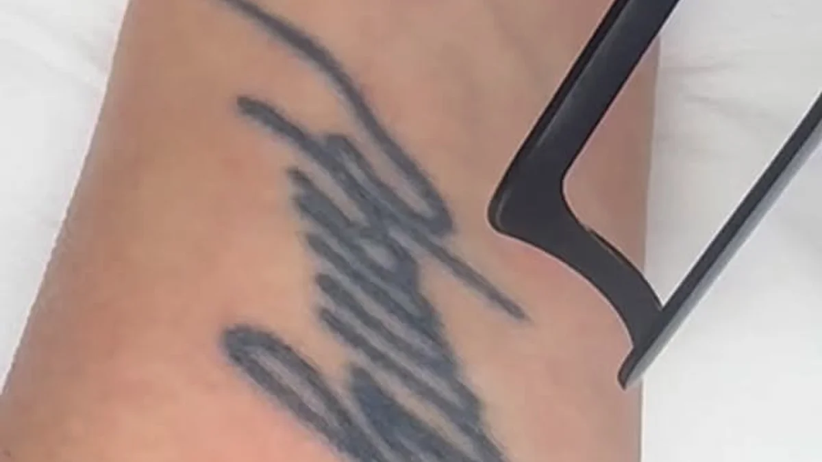 Tattoo Entfernung bei DeMas Beauty in Muttenz