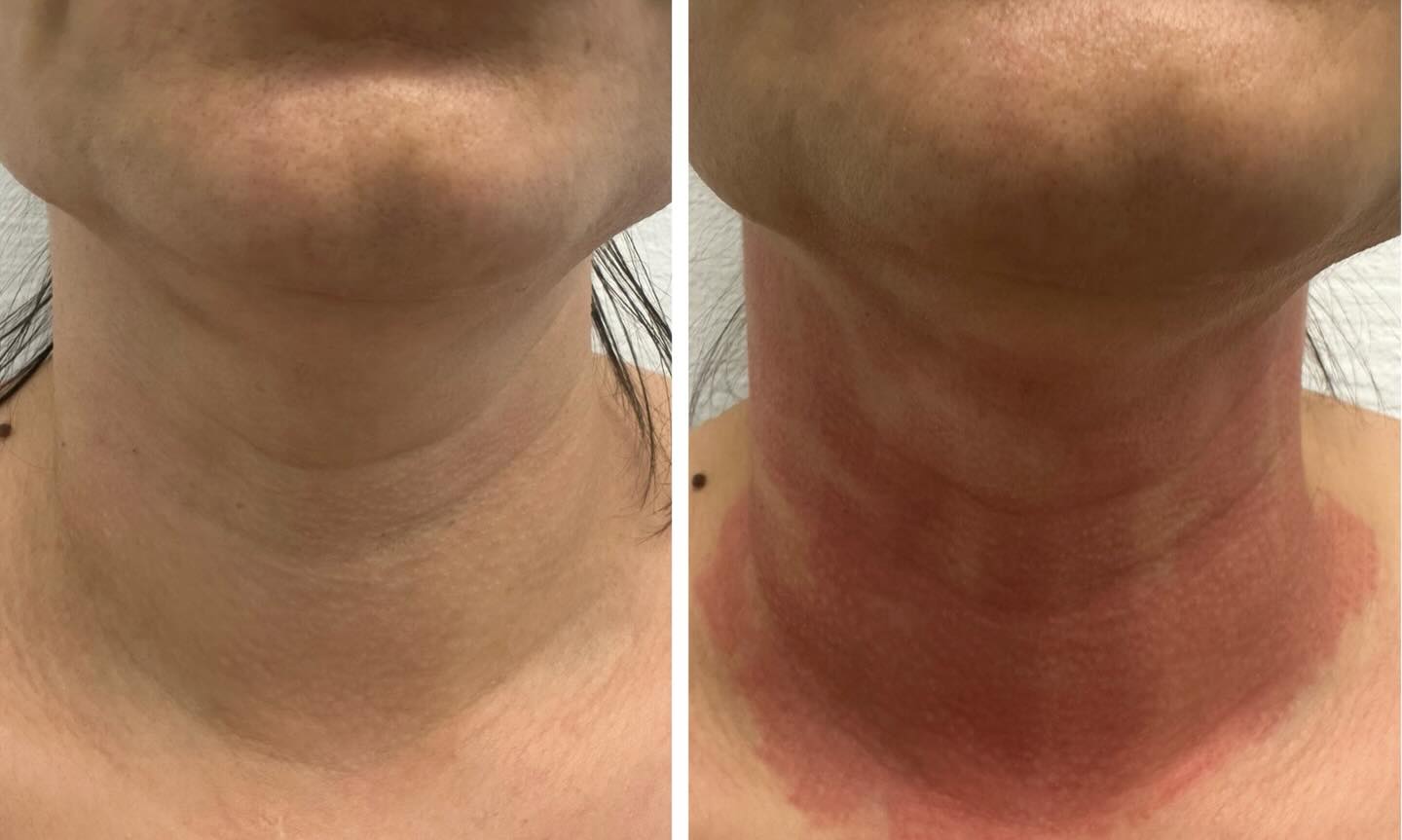 Fibroblast Plasma: Erfahrungen & Ergebnisse nach 3 Monaten