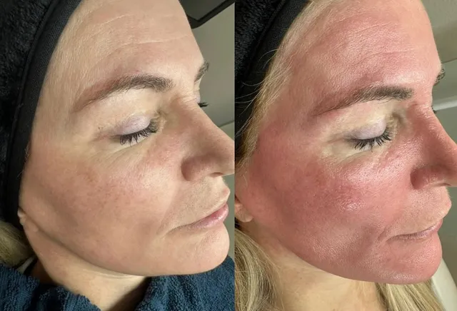 Carbon Laser Peeling vs. BioPeelX: Welche Behandlung passt zu dir?