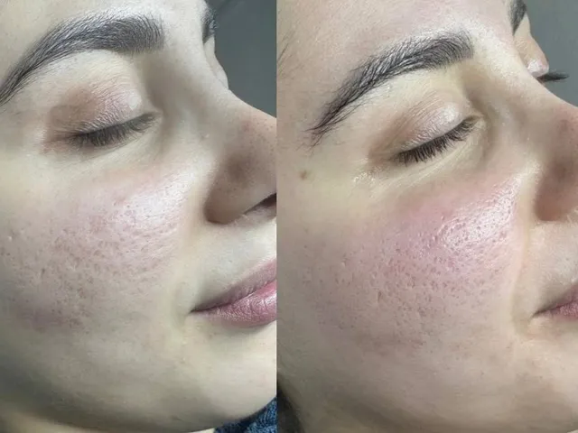 Microneedling: Der ultimative Guide für straffe Haut in Basel