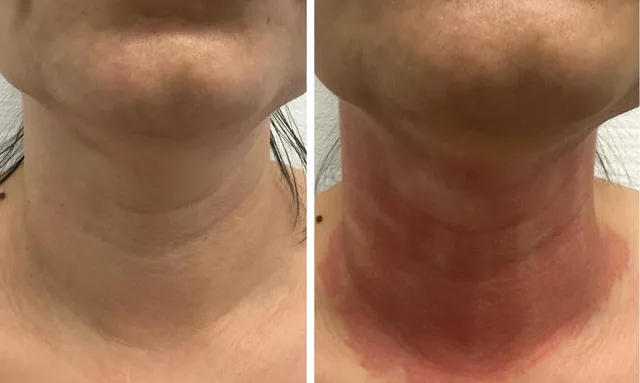 Fibroblast Plasma: Erfahrungen & Ergebnisse nach 3 Monaten